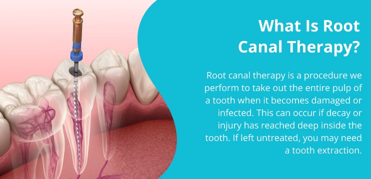 root canal