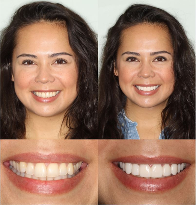 before after of womens smile