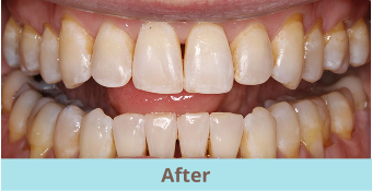 after clear aligners
