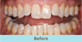 before clear aligners