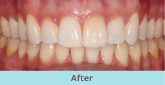 before clear aligners