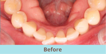 before clear aligners