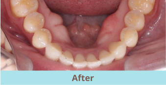 after clear aligners