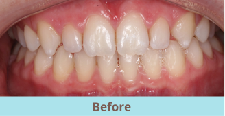 before bioclear