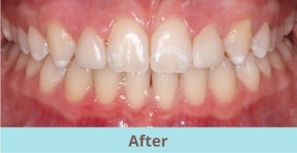 after bioclear