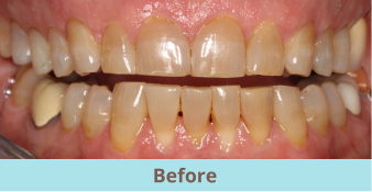 before teeth whitening