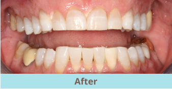 after teeth whitening