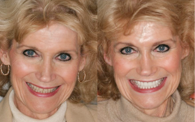 womens smile before and after